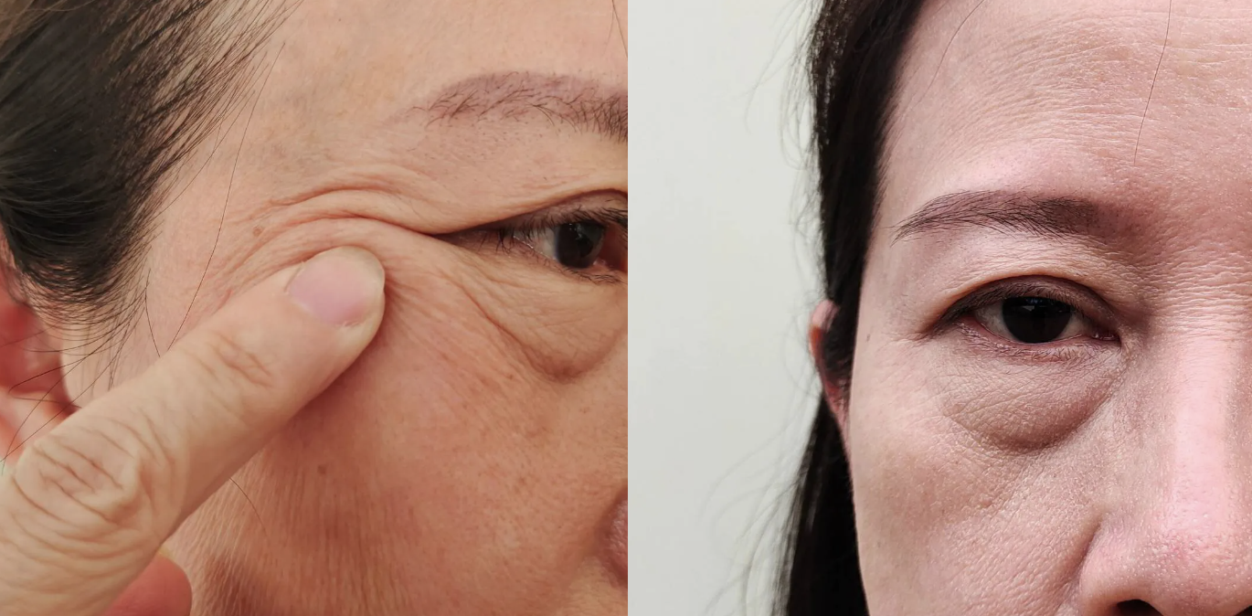 Blefaroplastia