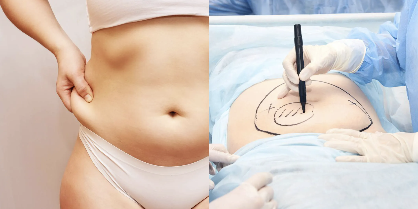 LiposuccionCorporal