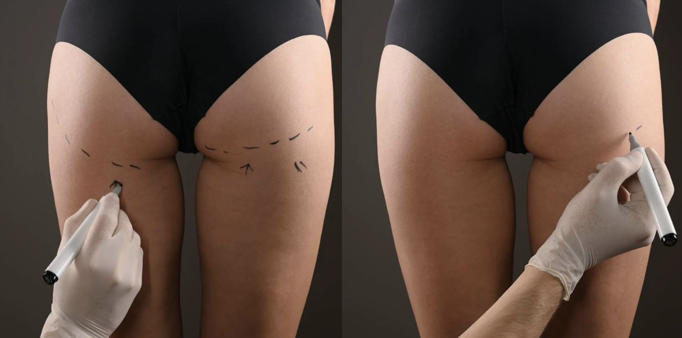 Lipotrasnferenciaengluteos